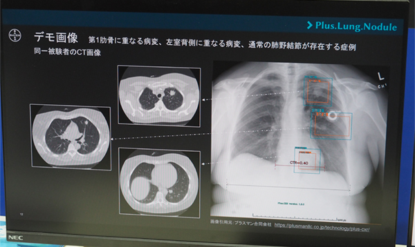 胸部CT画像の読影支援ソフトウエア「Plus.Lung.Nodule」