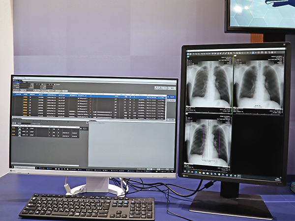 検像システム「iRad-QA」に提供される新機能「肋骨陰影減弱」