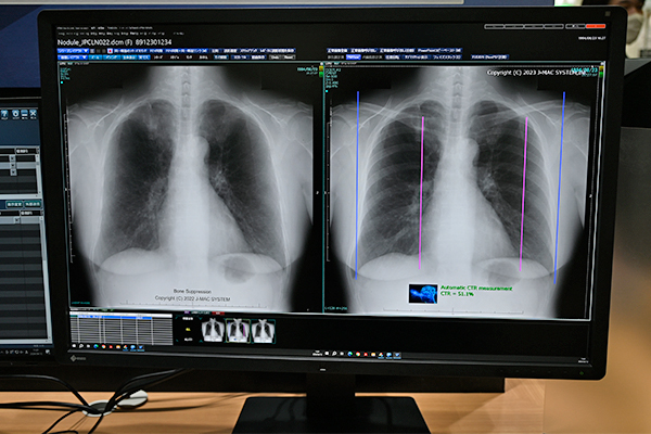 技術展示として紹介した「肋骨減弱機能」（左）と「心胸郭比自動計測機能」（右）