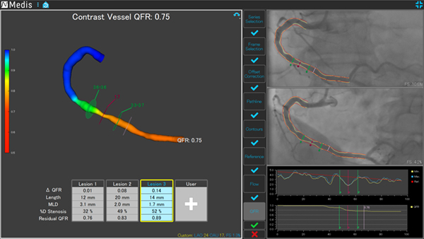 定量的冠血流比解析プログラム「Medis QFR」