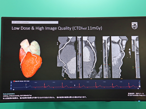 AIを活用した機能により低線量でブレのない心臓CT検査を実現