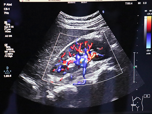超音波診断装置の最新ソフトウエア「VM10」に搭載された血流イメージ「Flow Viewer」