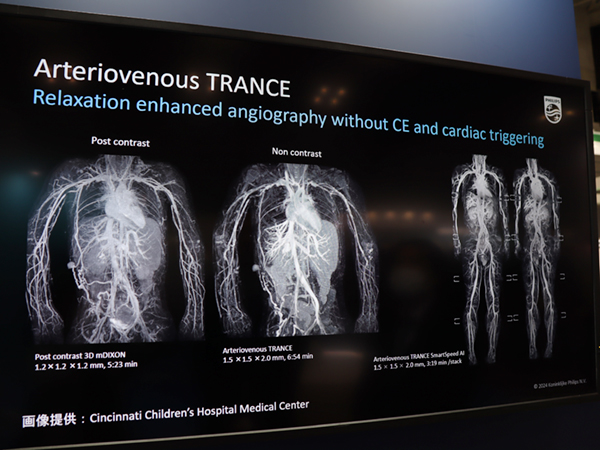 非造影・非同期で全身の血管を撮像可能な「AV-TRANCE」