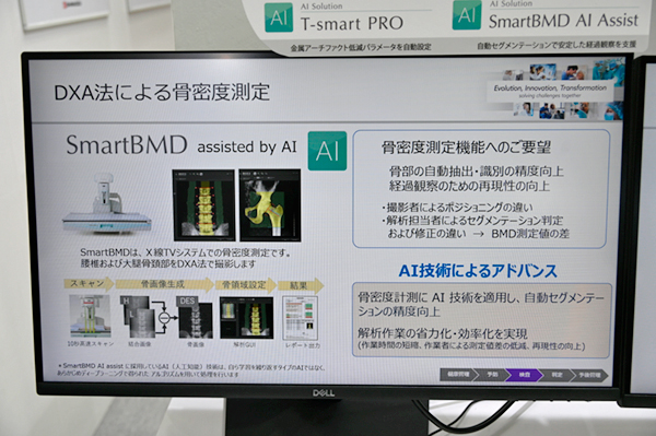 AI技術で骨領域の自動セグメンテーションを行い骨密度測定を支援する「SmartBMD AI Assist」