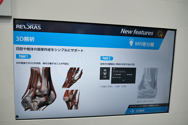 REVORASの3D解析の新たな機能の“MR骨分離”