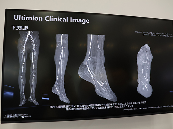 遊離腓骨弁移植術前のCTAによる腓骨動脈の走行確認では，腓骨動脈だけでなく足底動脈末梢まで描出