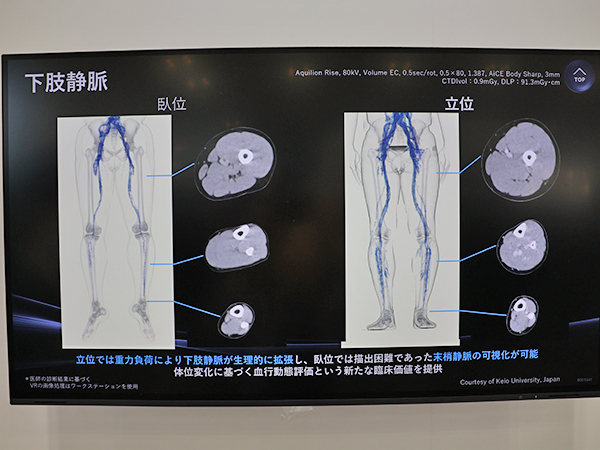 立位では重力負荷により下肢静脈が拡張する様子を観察でき，末梢静脈の可視化も可能