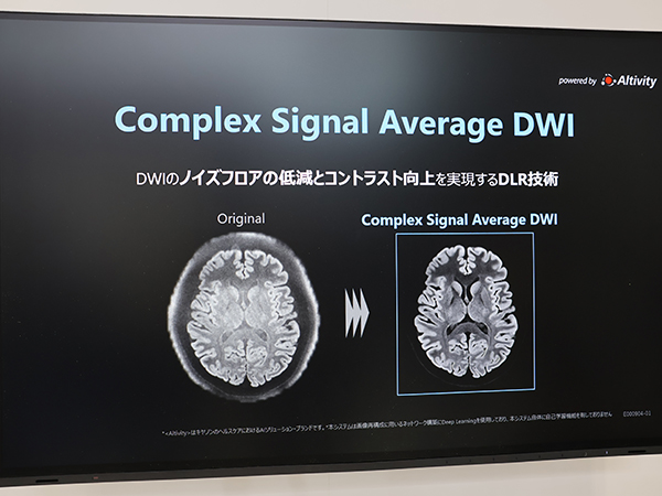 DWI特有のノイズを低減する「Complex Signal Average DWI」