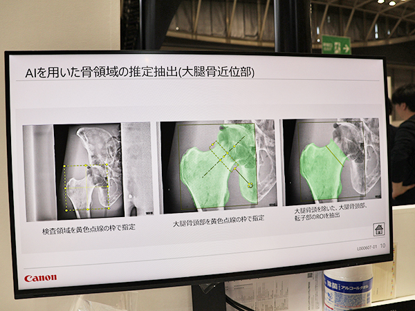 骨密度測定オプションではAIにより骨領域や椎体の境界線の推定を自動化