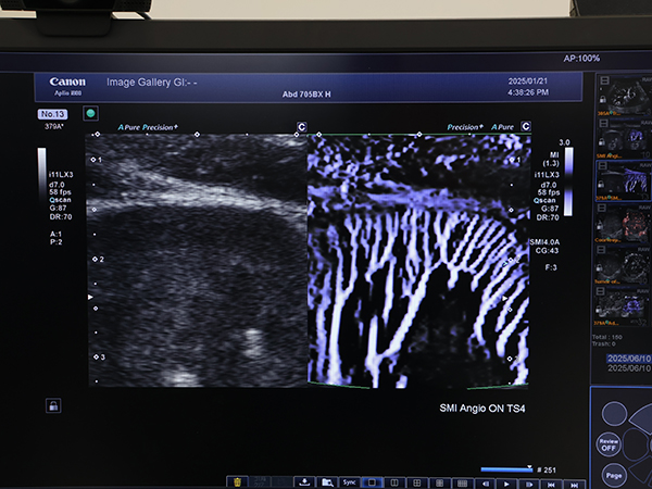 微細・低流速血流をより明瞭に描出する「SMI Angio mode」