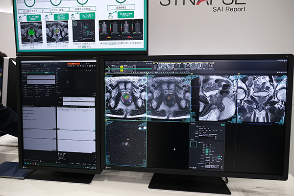 PI-RADSに準拠した読影を支援する「前立腺ビュー」