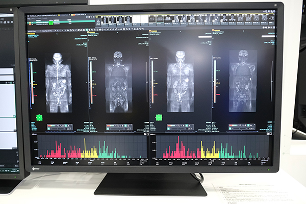 Whole Body Diffusion Weighted Imagingに適した「Body DWIビュー」