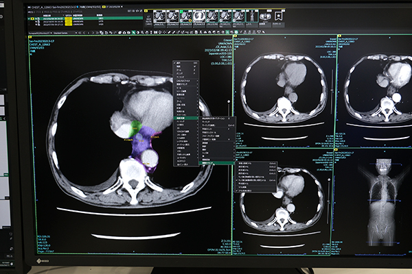 縦隔リンパ節のラベリング機能