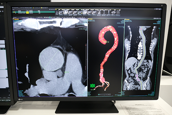 複数瘤の観察に対応した大動脈ビュー