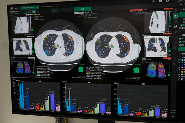 間質性肺疾患解析