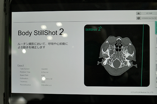 頭部，腹部での動き補正を可能にする「Body StillShot2」