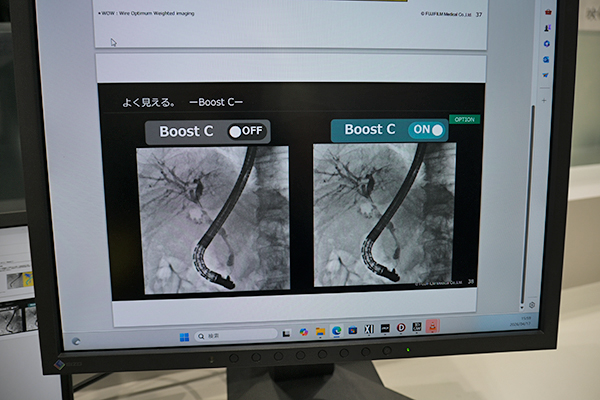 AIを活用した造影剤強調処理「Boost C」では造影剤使用量を削減したERCPが可能