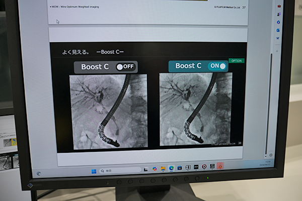 AIを活用した造影剤強調処理「Boost C」では造影剤使用量を削減したERCPが可能