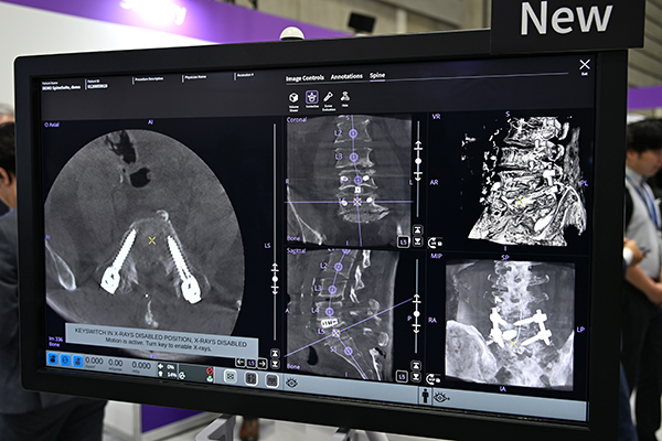 脊椎手術を支援する「Spine Suite」3D画像上でスクリューを認識して自動ナンバリング