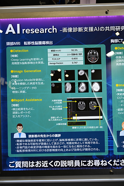 92.5％という高い感度を実現している転移性脳腫瘍検出AI