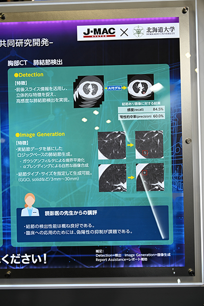 胸部CT画像から84.5％の感度で肺結節候補を検出
