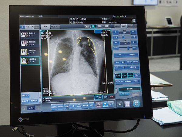 STAT Linkが検出した気胸疑い症例