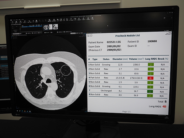 胸部CT画像での病変候補発見支援機能