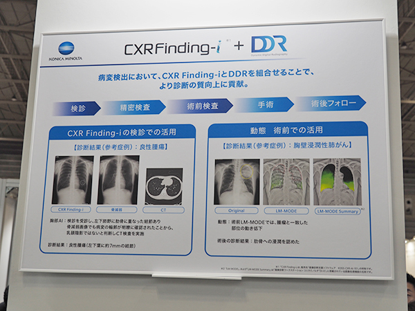 CXR Finding-iとDDRの組み合わせによる診断の質の向上を提案。