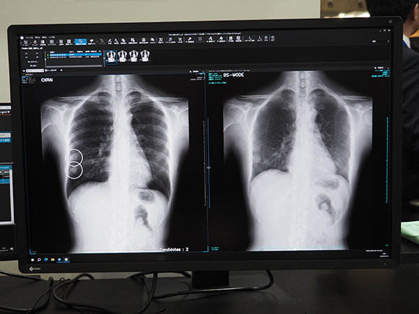 CXR Finding-i（左）とDDR（右）を併用した病変検出のイメージ。Bone Suppression処理と動画の組み合わせにより，高精度な病変検出が期待できる。
