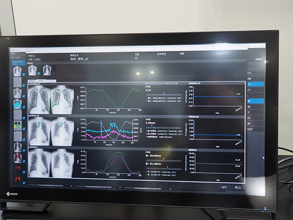 肺野面積の変化や横隔膜変位を数値とグラフで明確に表示可能に。