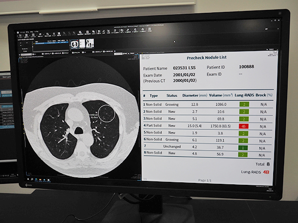 胸部CT画像での病変候補発見支援機能では，結節の種類や体積，Lung-RADS分類などを検出，表示する。