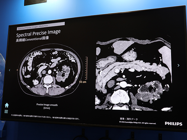 膵臓がんの早期発見を支援するAI画像再構成「Spectral Precise Image」