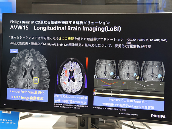 FLAIR* Imageを自動生成が可能な「Longitudinal Brain Imaging（LoBI）」
