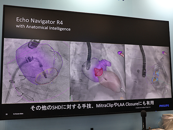 「EchoNavigator R4」では三次元解剖学的モデルの重ね合わせ表示が可能に