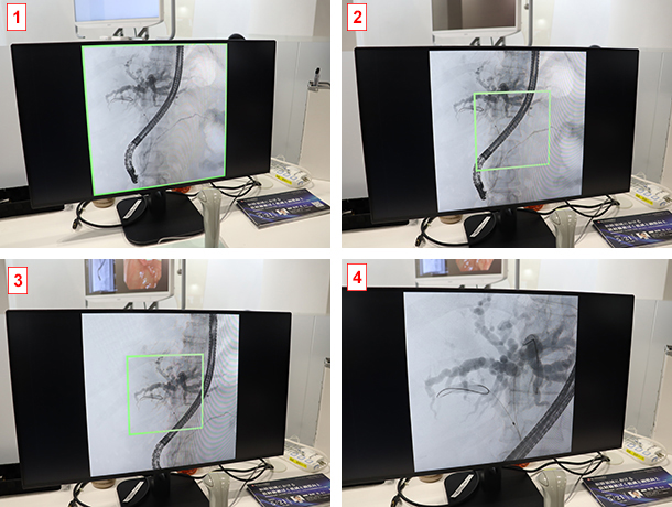 FPD画角内視野移動機能「Smart FOV」。天板を動かすことなく画角内の視野移動や関心領域内の画像の全画面拡大表示ができるため，より安全な内視鏡検査の実現に貢献