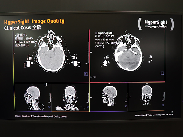 治療計画CTとHyperSightの画像の比較