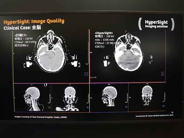 治療計画CTとHyperSightの画像の比較（全脳）