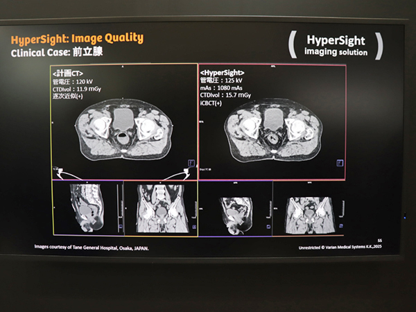 治療計画CTとHyperSightの画像の比較（前立腺）