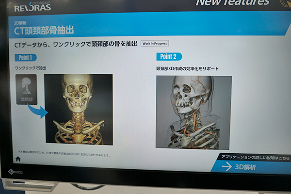 3D解析・CT頭頸部骨抽出