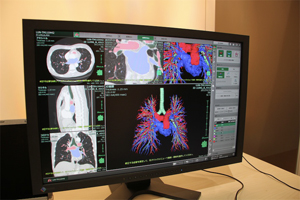 肺野血管の動静脈分離「SYNAPSE VINCENT Ver.3.0」