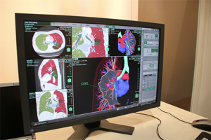 肺切除シミュレーション「SYNAPSE VINCENT Ver.3.0」