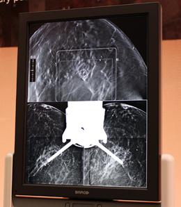 トモバイオプシーの位置決め画面（上：トモシンセシス画像上でターゲットを指定，下：ステレオ画像）