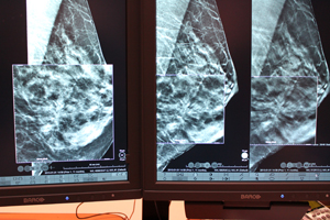 2D（左），C-View（中央），トモシンセシス（右）の比較