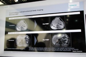 呼吸移動アーチファクトを除去する“StarVIBE”