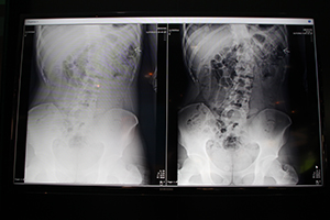 Virtual Grid（右）による臨床画像（日本人の腹部）