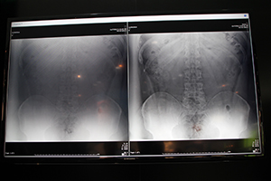 大柄なアメリカ人の腹部画像。Virtual Grid（右）で画質が向上している。