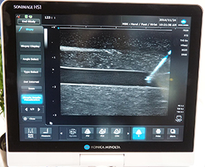 穿刺位置を強調し手技を支援