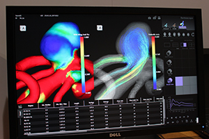 流体力学を応用したソフトウエア“hemoscope”