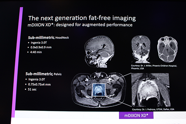 全身領域の脂肪抑制画像を可能にする“mDIXON XD”