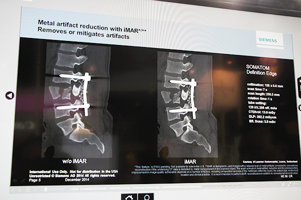 金属アーチファクト低減技術 iMARによる臨床画像（腰椎）